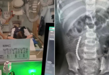 Un nene de 12 años fue operado de urgencia luego de someterse a un peligroso reto de TikTok