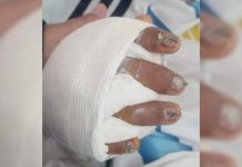 “Tiene el 95% de la mano destruida”: la mamá de un alumno accidentado en una escuela de Jujuy denunció abandono